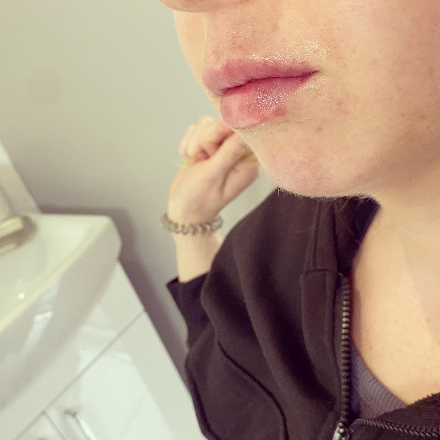 Close up view of after a more natural lip filler