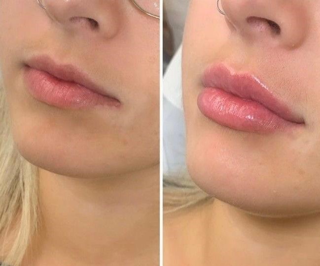 Photos of before and after a woman has had lip fillers