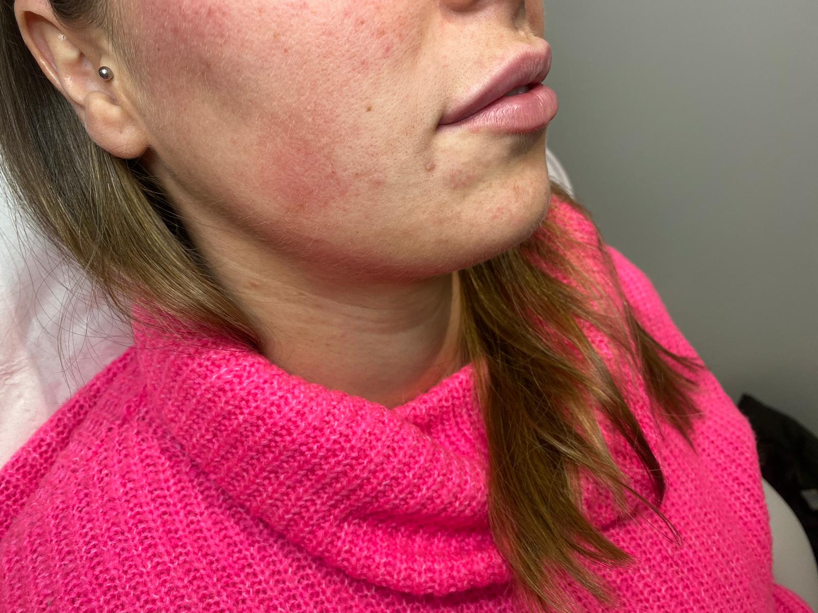 Close up Photo of womans lips after filler