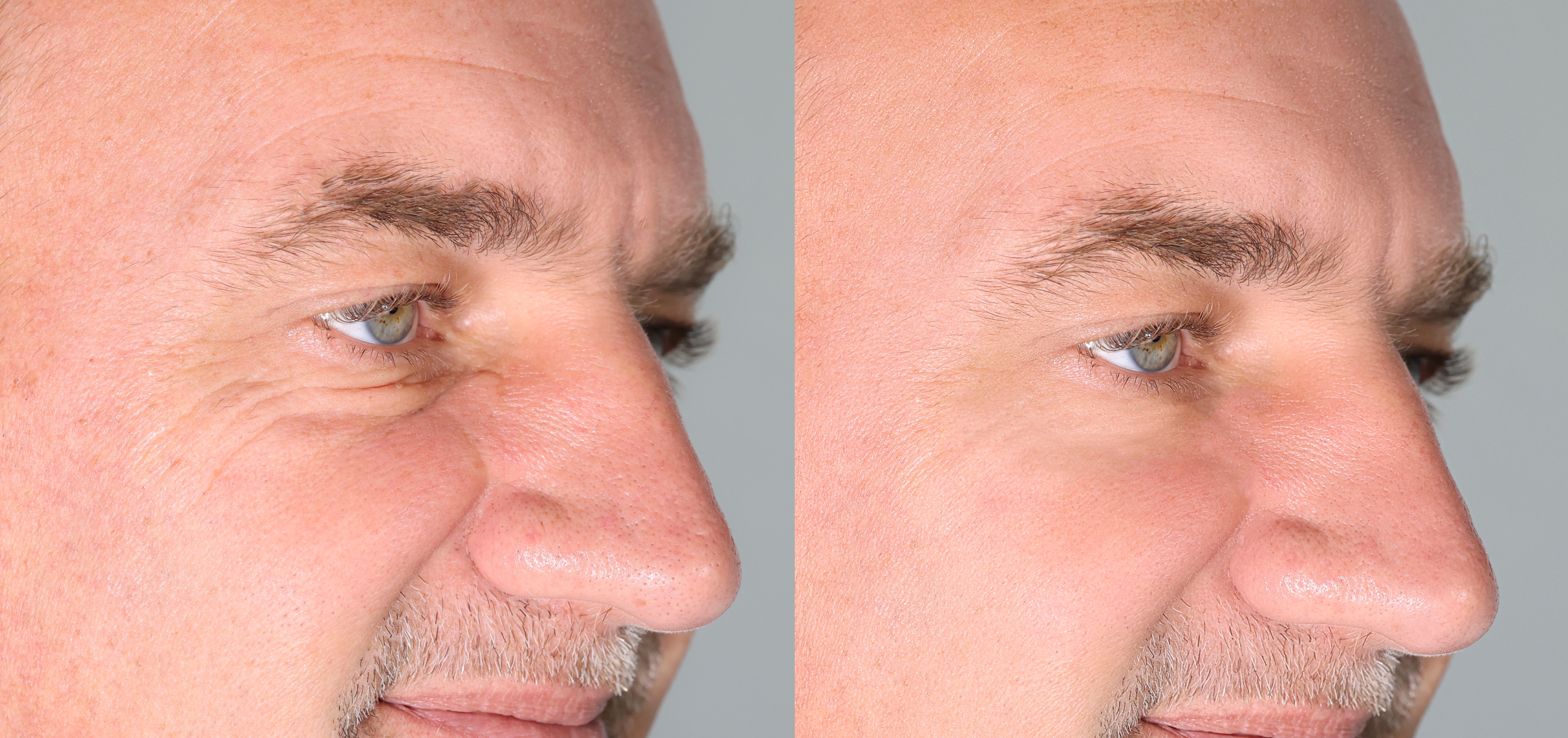 Man before and after botox around eyes