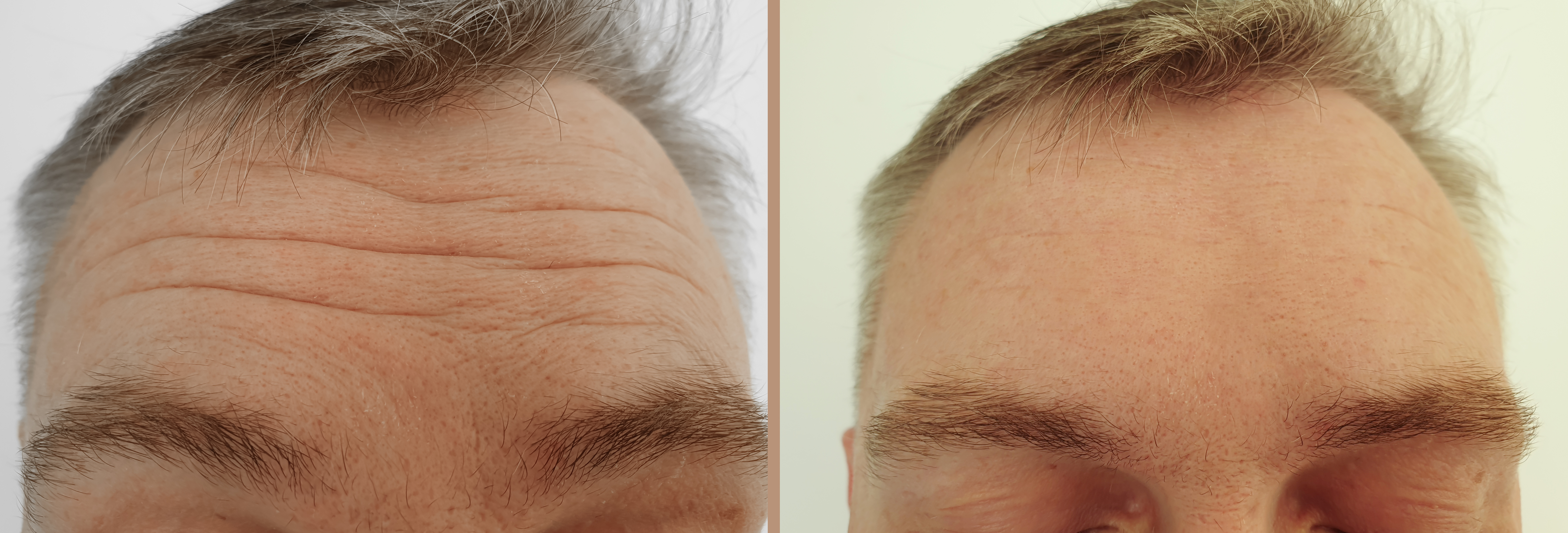 male forehead wrinkles before and after treatment