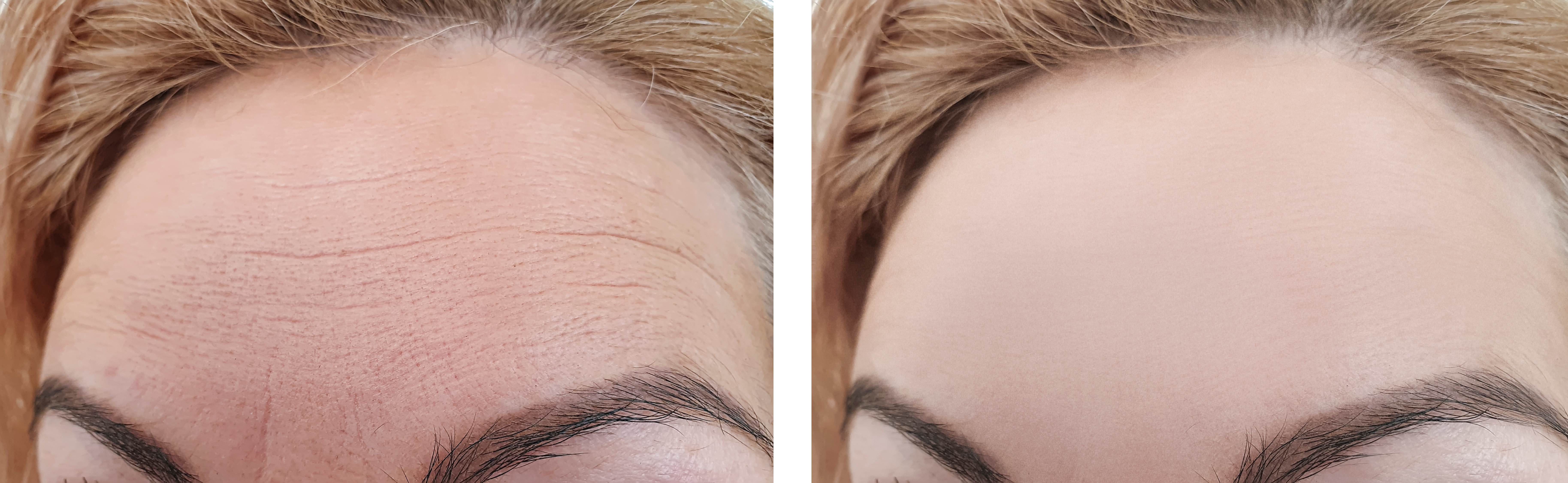 Close up of womans forehead before and after botox